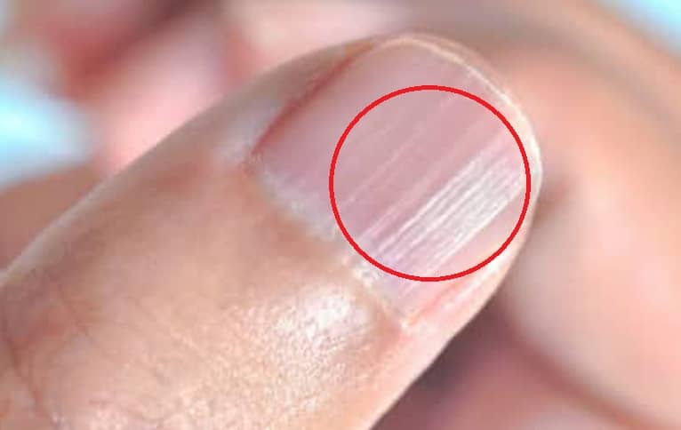 What Do These Vertical Ridges On Your Nails Tell About Your Health?